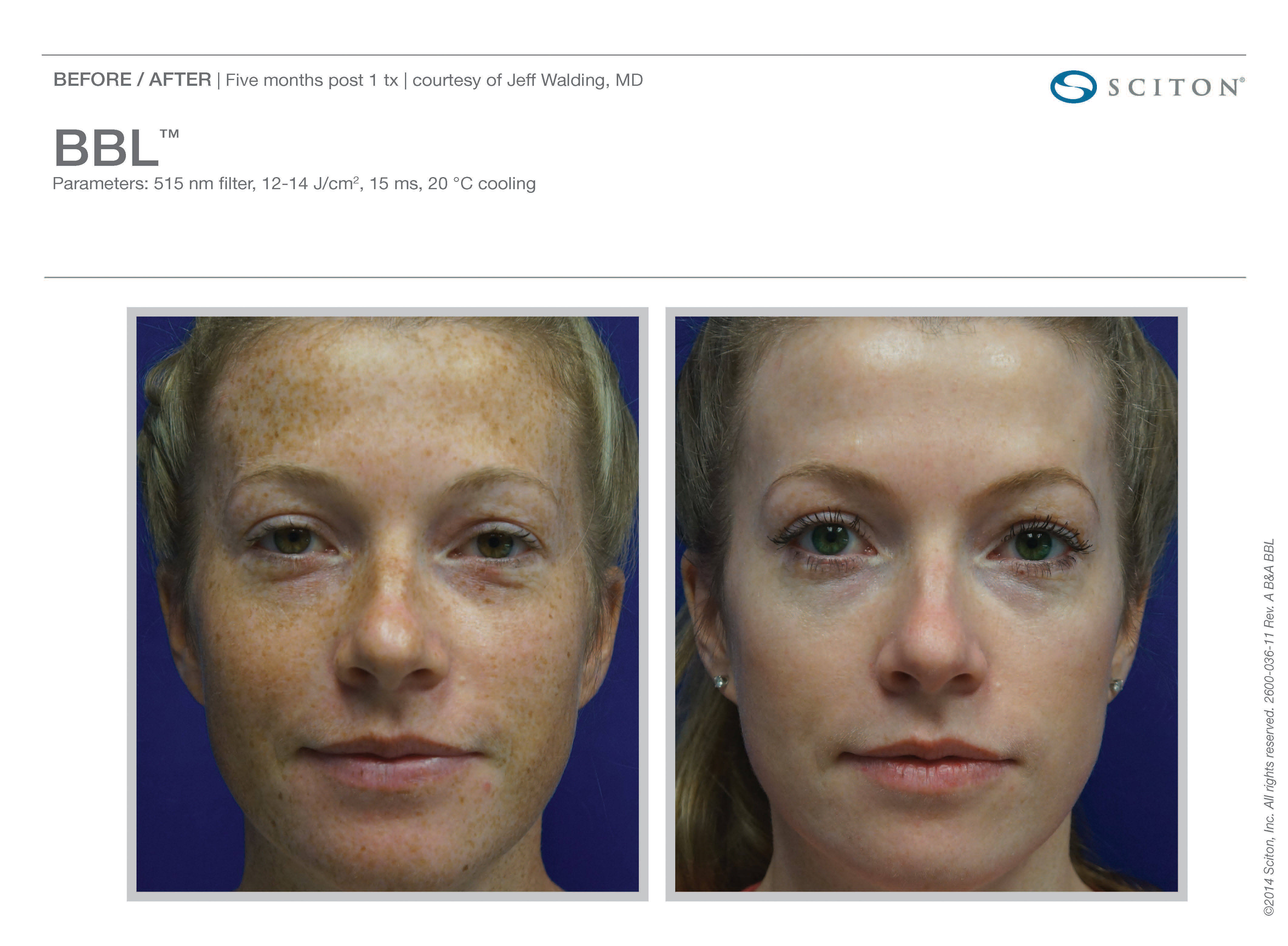 Facial Resurfacing: The Ultimate Guide To Younger Skin - 1emh8ny